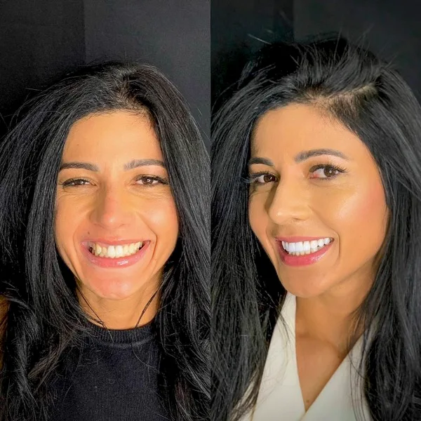 Paciente com lentes de contato dental